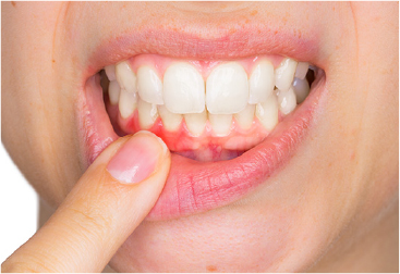 歯周病からの予防
