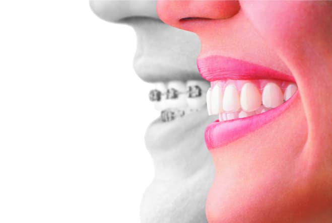 マウスピース型矯正歯科装置（インビザライン）の特徴