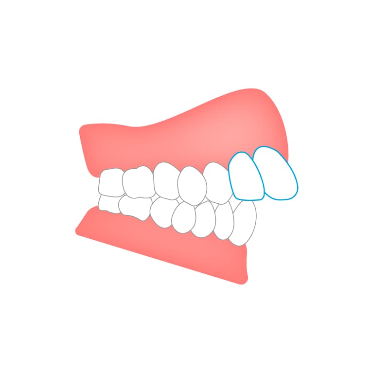 骨格性の出っ歯（上顎前突）