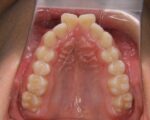 出っ歯・口ゴボ治療例１（治療前上顎咬合面）