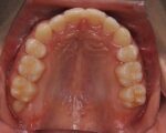 出っ歯・口ゴボ治療例１（治療後上顎咬合面）