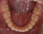出っ歯・口ゴボ治療例１（治療後下顎咬合面）