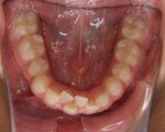 出っ歯・口ゴボ治療例１（治療前下顎咬合面）
