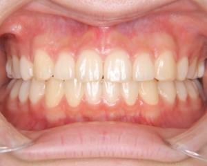 すきっ歯治療例１（治療後正面）