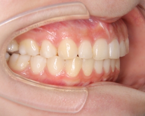 すきっ歯治療例１（治療後側方）
