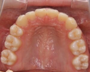 すきっ歯治療例１（治療後上顎咬合面）