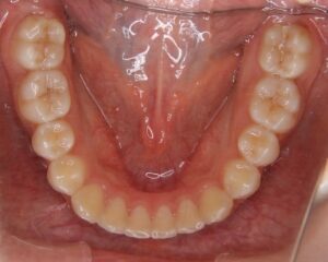すきっ歯治療例１（治療後下顎咬合面）