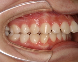 すきっ歯治療例１（治療前側方）