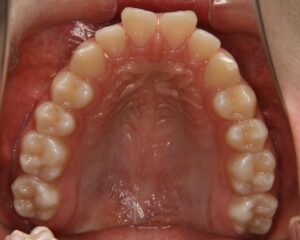 すきっ歯治療例１（治療前上顎咬合面）