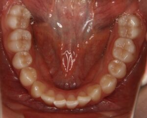 すきっ歯治療例１（治療前下顎咬合面）