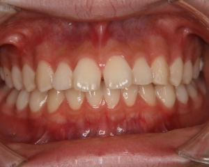 すきっ歯治療例１（治療前正面）