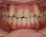 叢生・八重歯 治療例１（治療前正面）