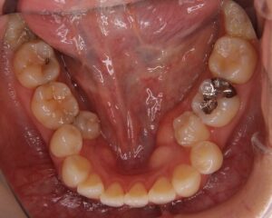 叢生・八重歯 治療例１（治療前下顎咬合面）