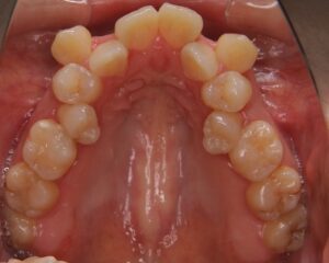 叢生・八重歯 治療例１（治療前上顎咬合面）