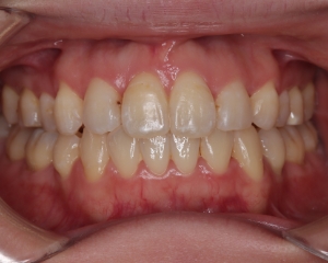叢生・八重歯 治療例１（治療後正面）