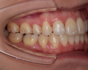 叢生・八重歯 治療例１（治療後側方）