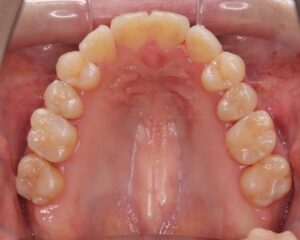 叢生・八重歯 治療例１（治療後上顎咬合面）