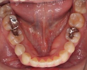 叢生・八重歯 治療例１（治療後下顎咬合面）