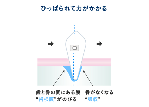 痛みが出る原因2