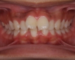 出っ歯・口ゴボ治療例１（治療前正面）