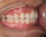 出っ歯・口ゴボ治療例１（治療後側方）