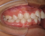 出っ歯・口ゴボ治療例１（治療前側方）