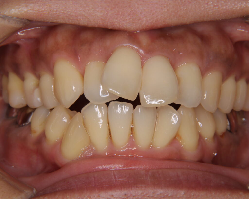 出っ歯・口ゴボ治療例５（治療前正面）