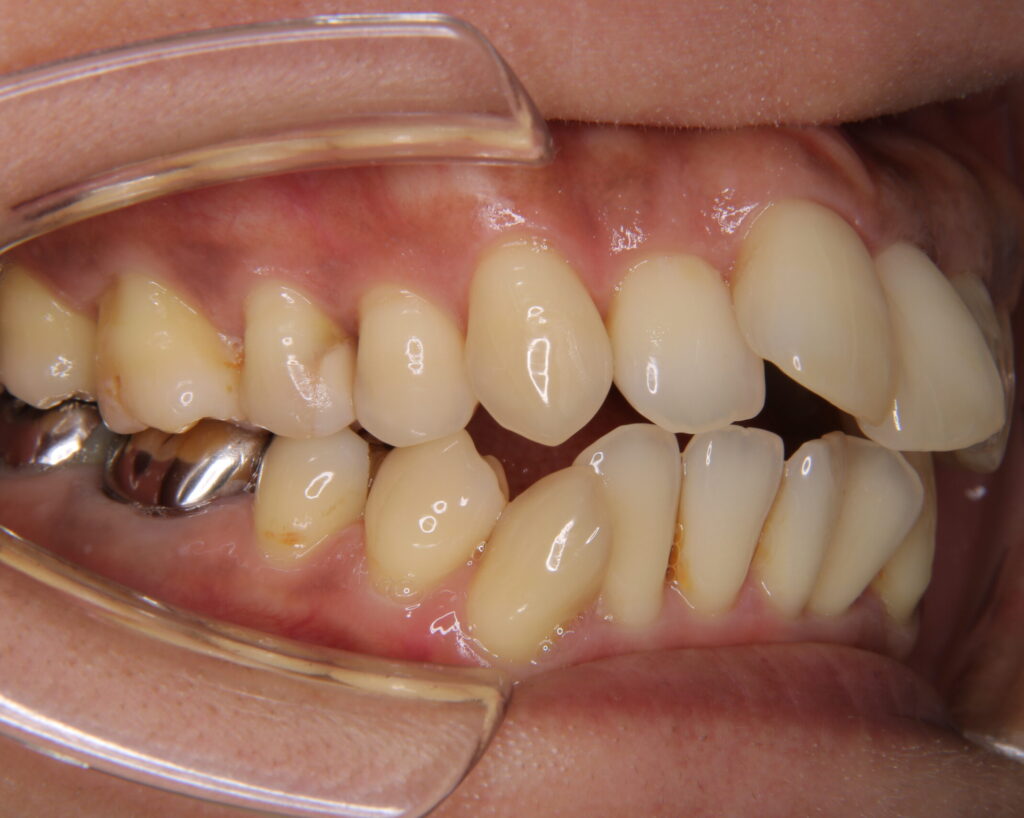 出っ歯・口ゴボ治療例５（治療前側方）