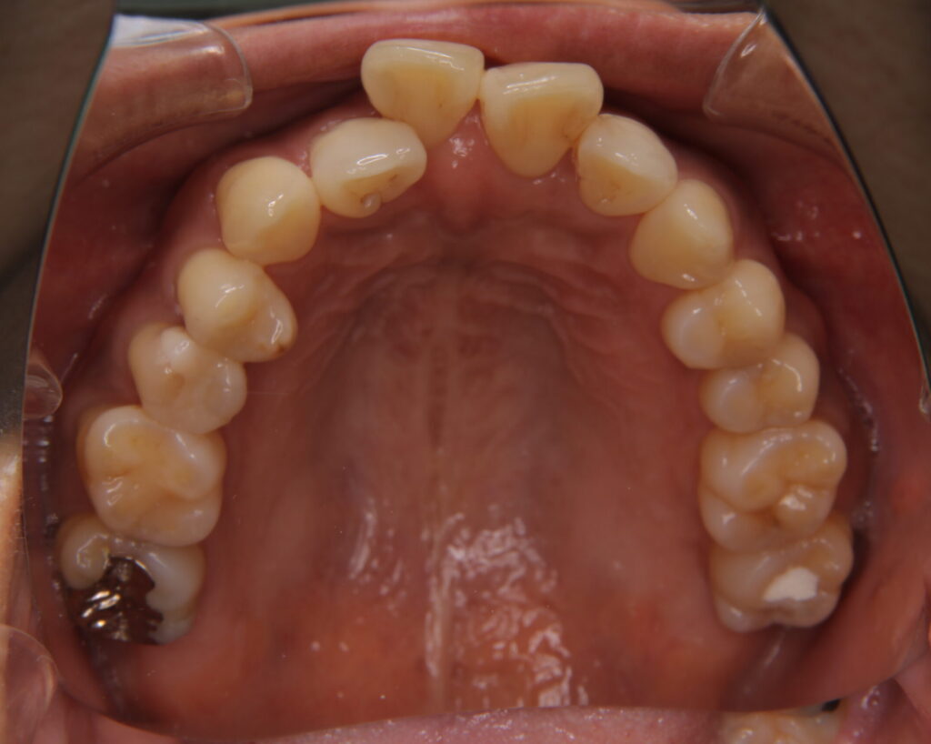 出っ歯・口ゴボ治療例５（治療前上顎咬合面）