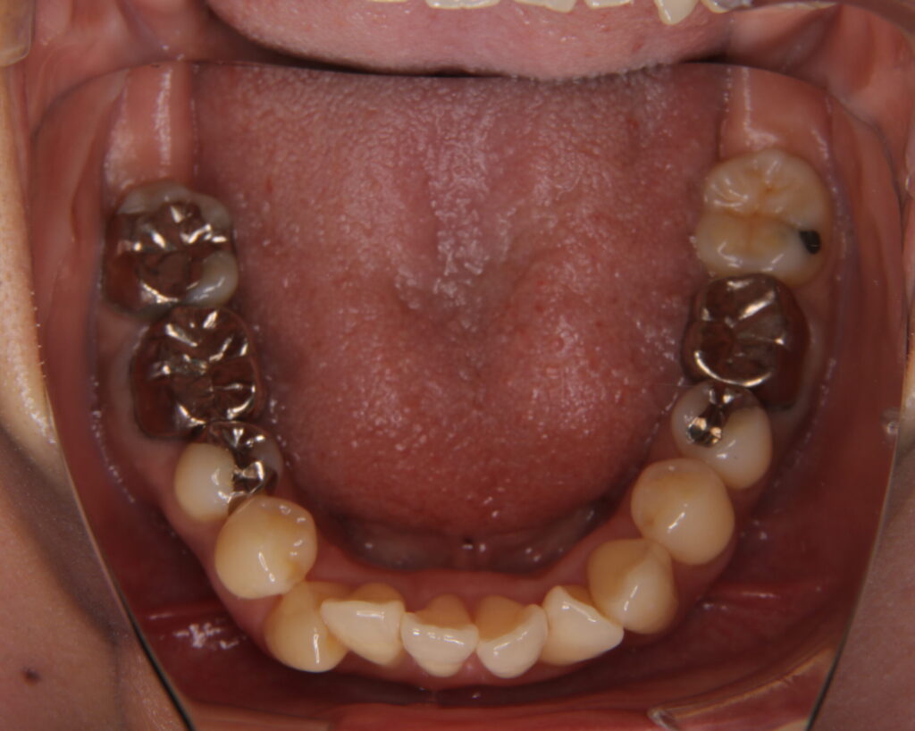 出っ歯・口ゴボ治療例５（治療前下顎咬合面）