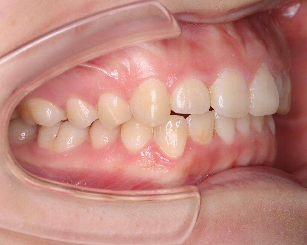 叢生・八重歯の治療例３（治療後側方）