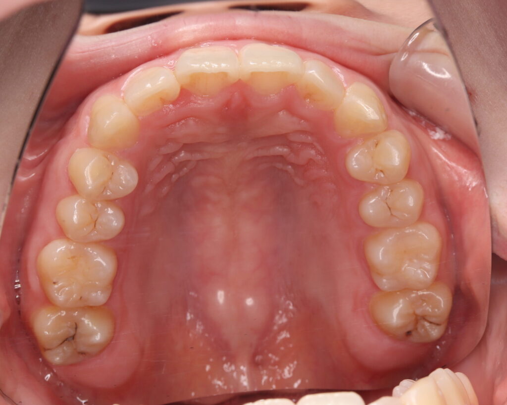 叢生・八重歯の治療例３（治療後上顎咬合面）
