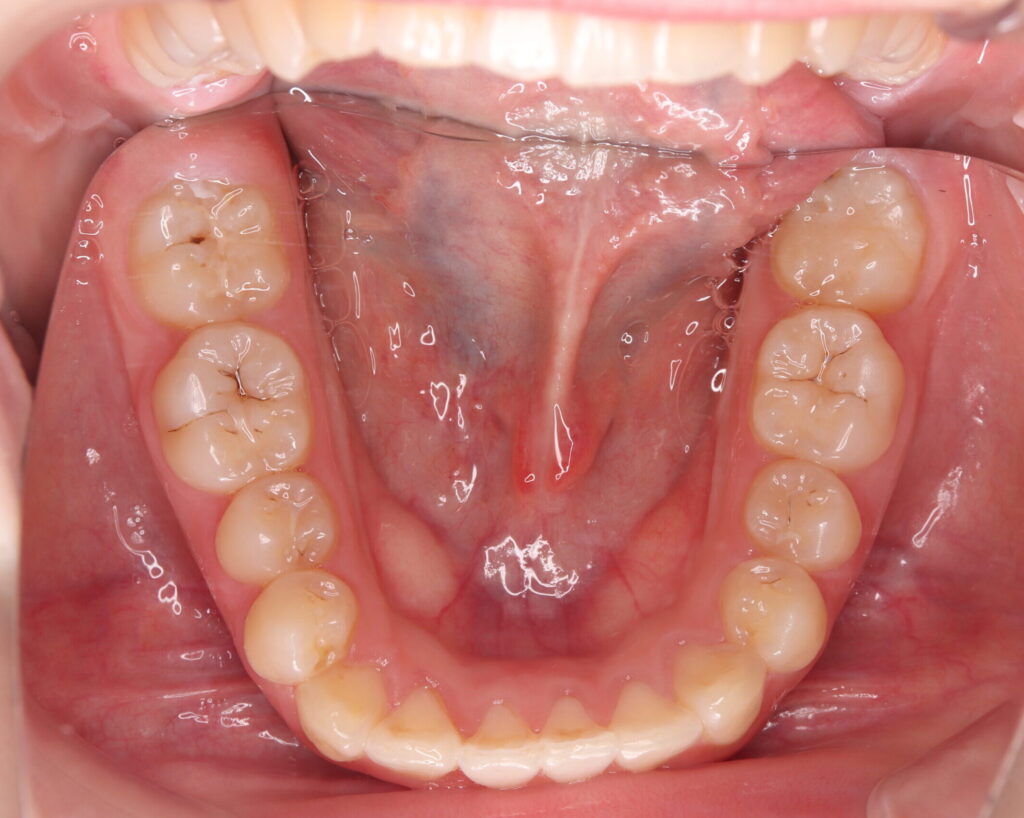叢生・八重歯の治療例３（治療後下顎咬合面）