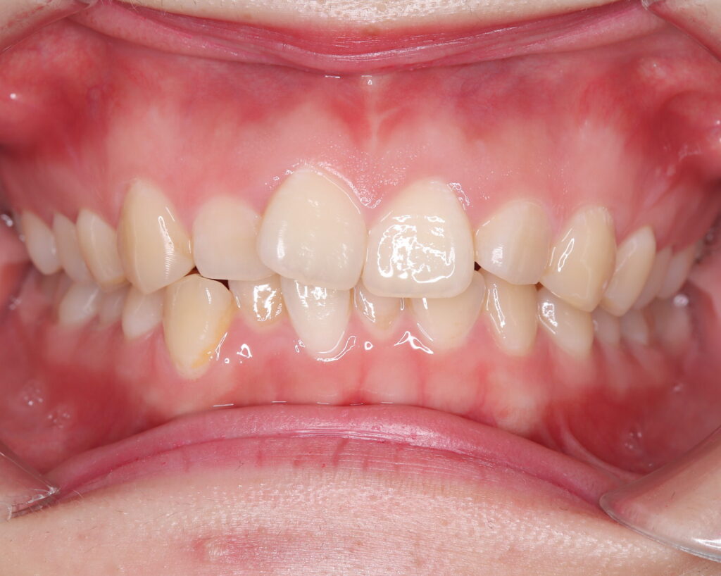 叢生・八重歯の治療例３（治療前正面）