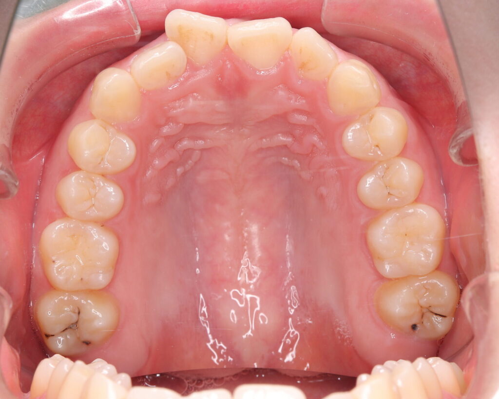 叢生・八重歯の治療例３（治療前上顎咬合面）