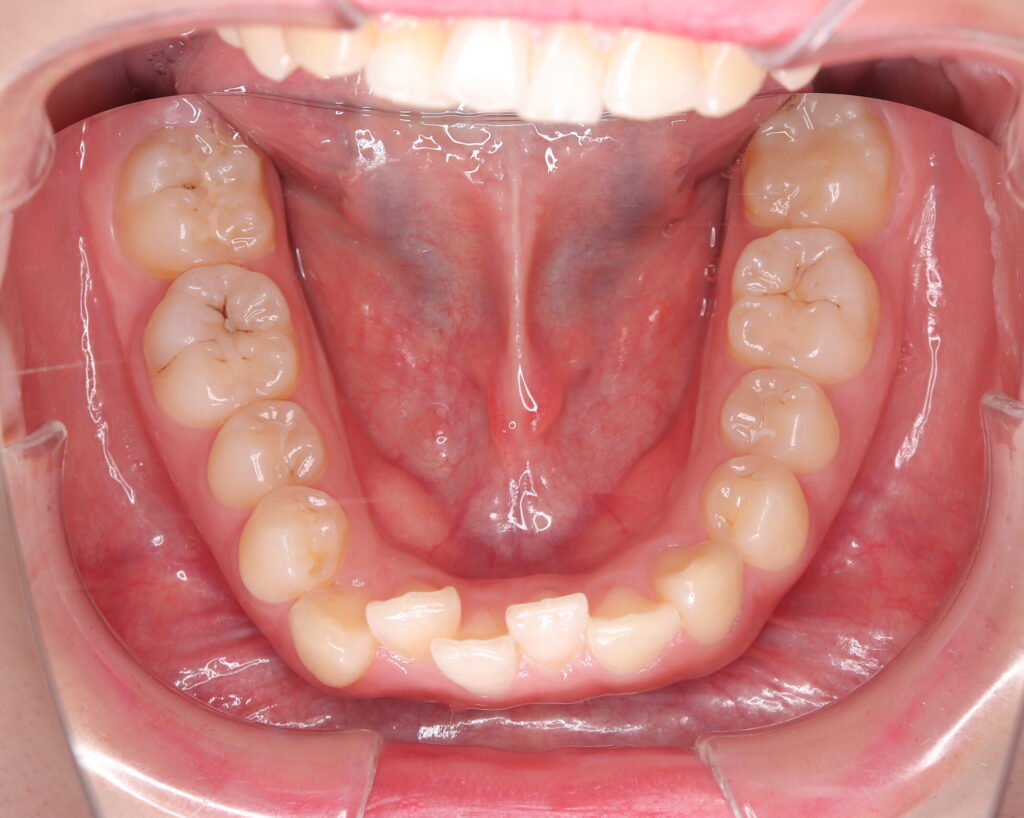 叢生・八重歯の治療例３（治療前下顎咬合面）