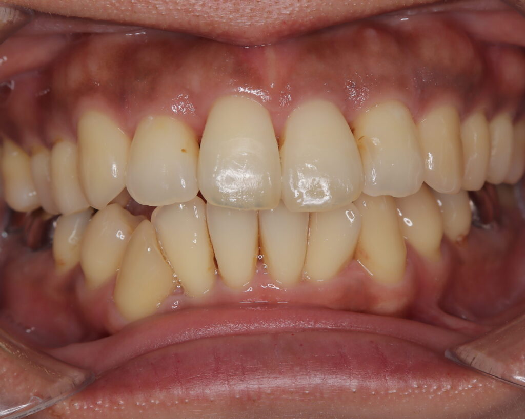 出っ歯・口ゴボ治療例５（治療後正面）