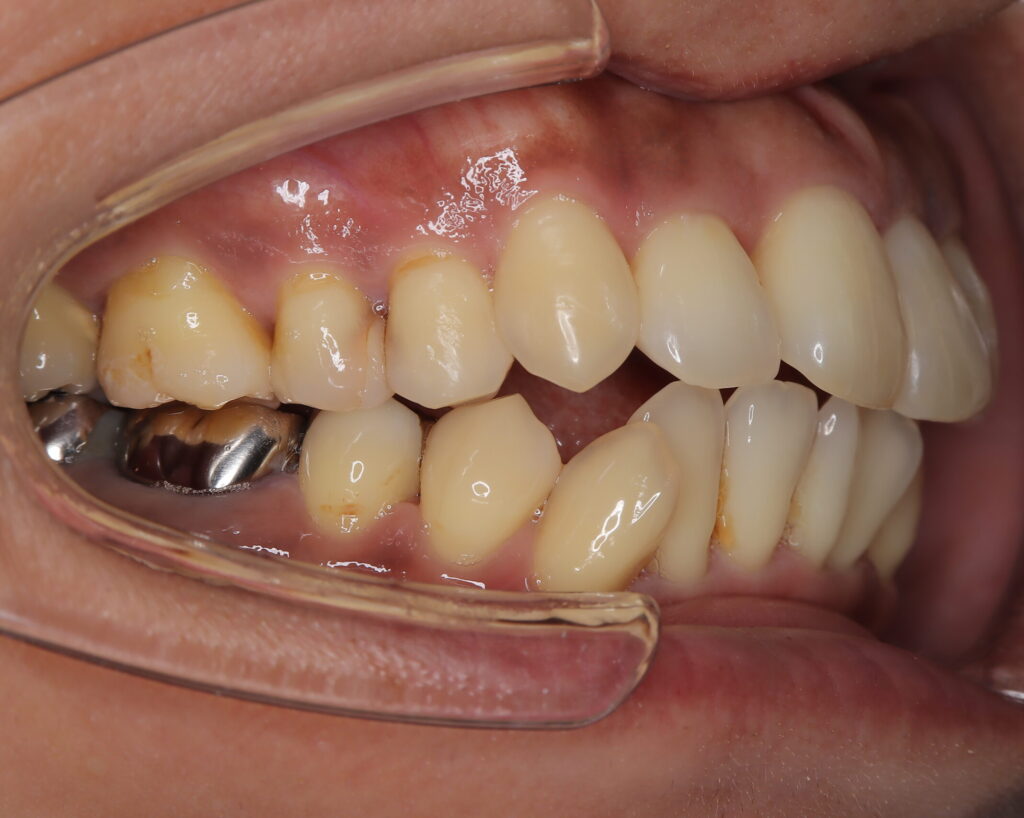 出っ歯・口ゴボ治療例５（治療後側方）