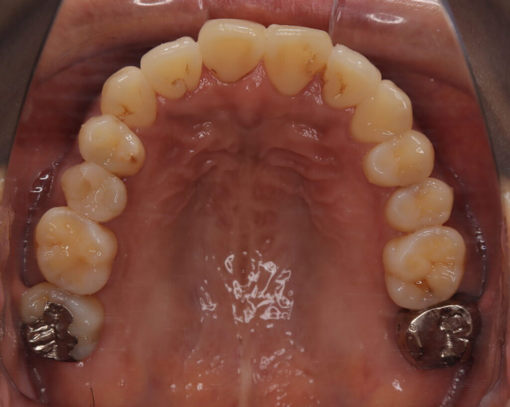 出っ歯・口ゴボ治療例５（治療後上顎咬合面）