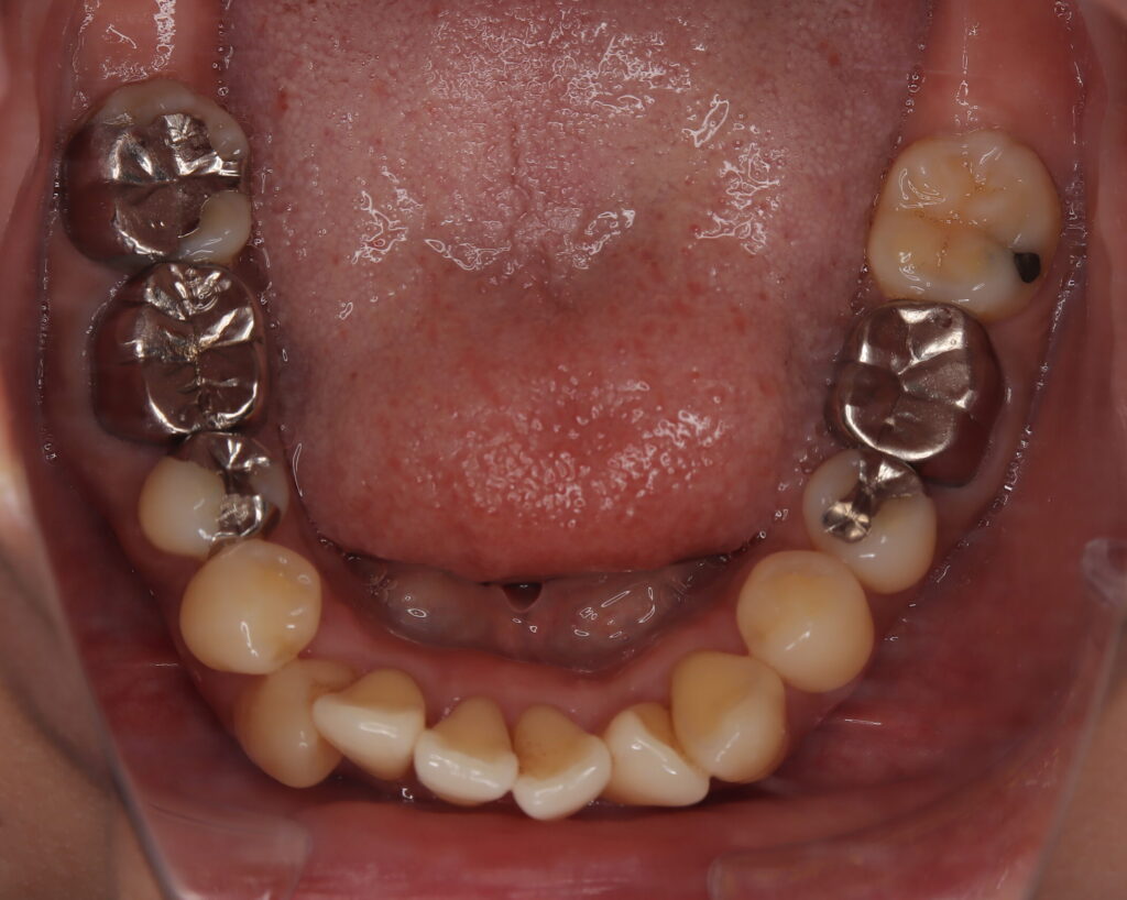出っ歯・口ゴボ治療例５（治療後下顎咬合面）