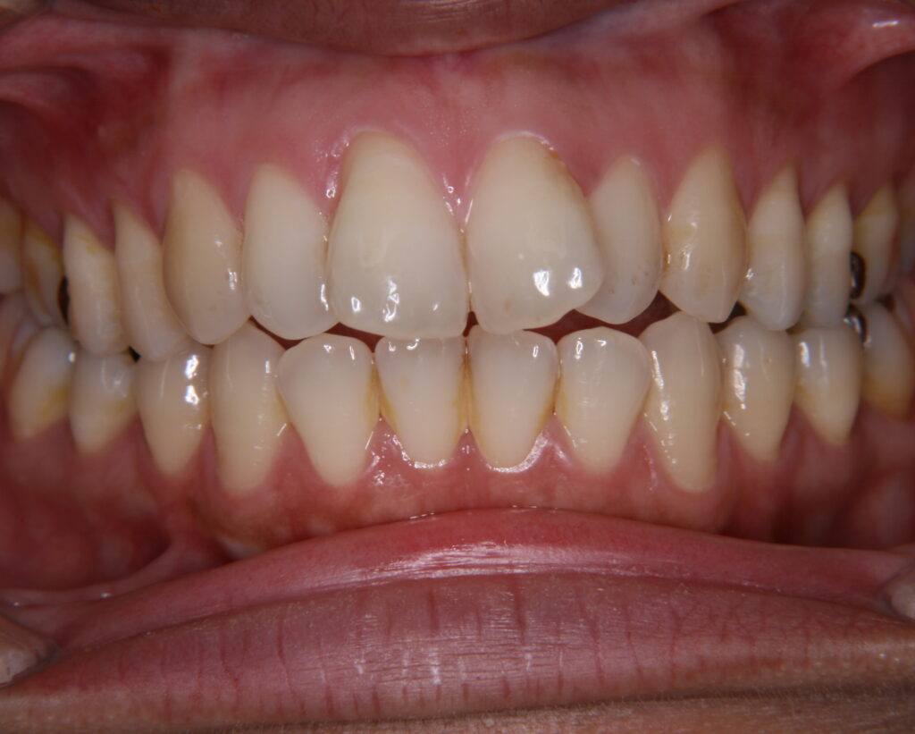 出っ歯・口ゴボ治療例３（治療前正面）