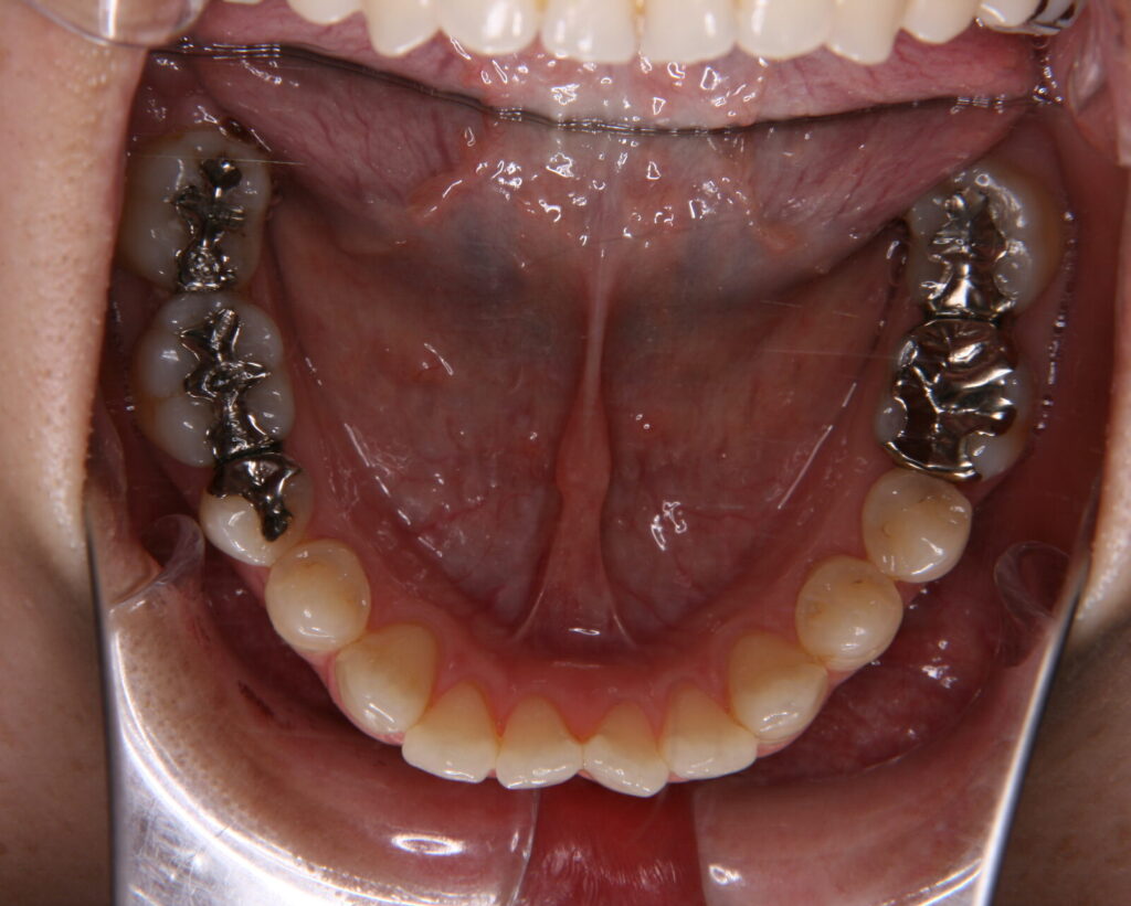 出っ歯・口ゴボ治療例３（治療前下顎咬合面）