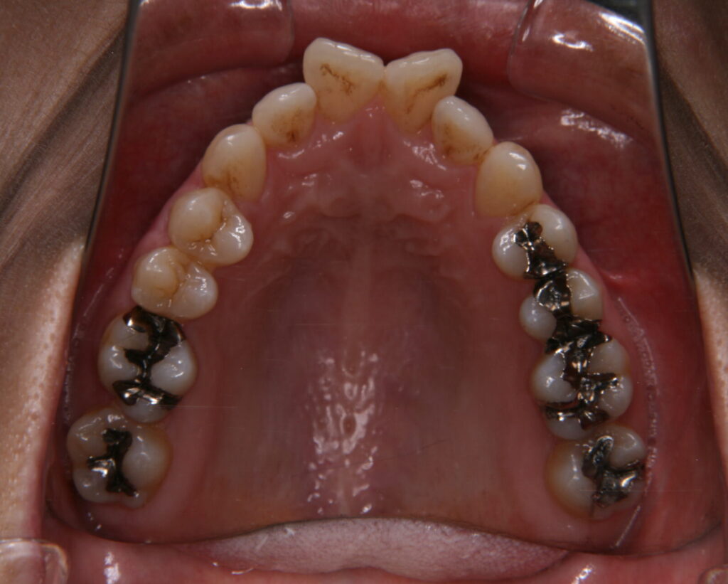 出っ歯・口ゴボ治療例３（治療前上顎咬合面）
