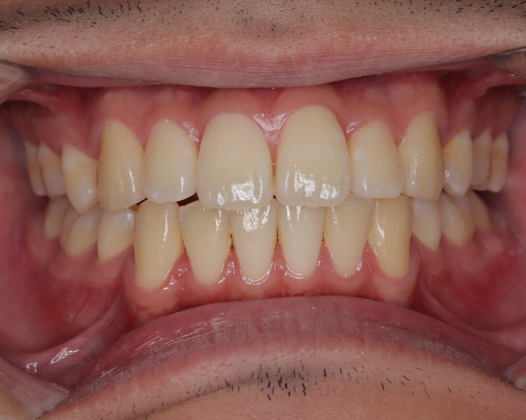 出っ歯・口ゴボ治療例４（治療後正面）