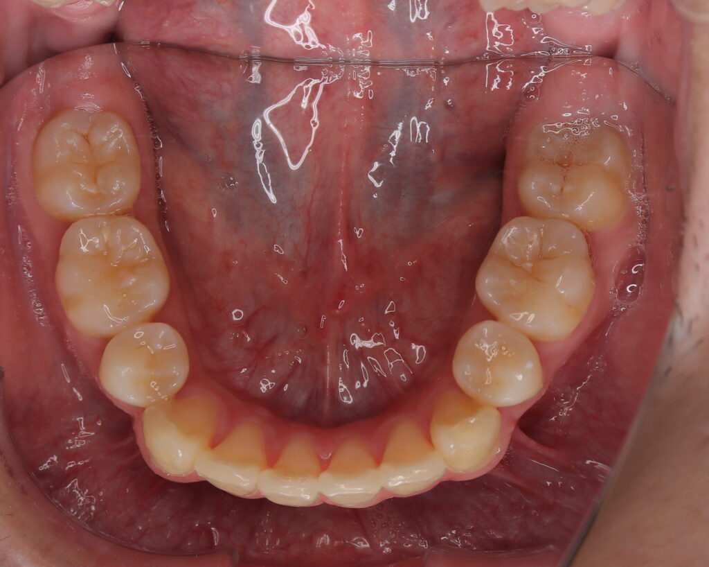 出っ歯・口ゴボ治療例４（治療後下顎咬合面）