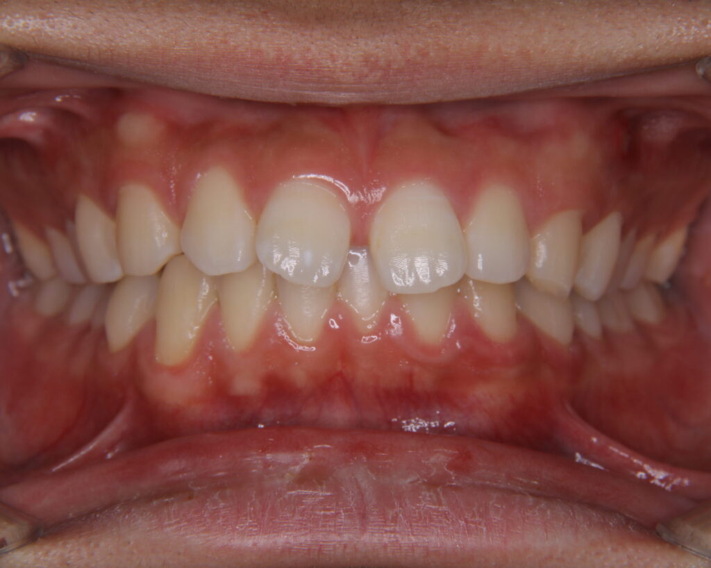 すきっ歯治療例２（治療前正面）