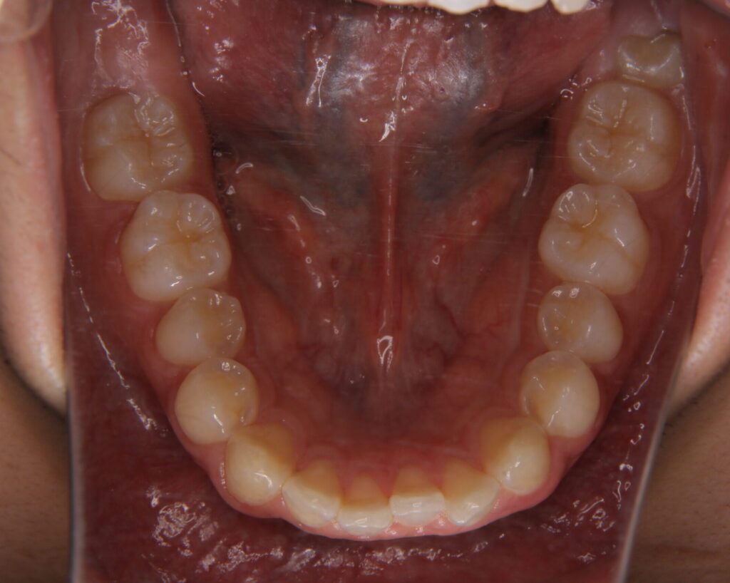 すきっ歯治療例２（治療前下顎咬合面）