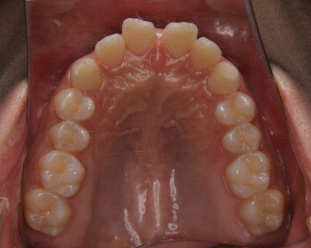 すきっ歯治療例２（治療前上顎咬合面）