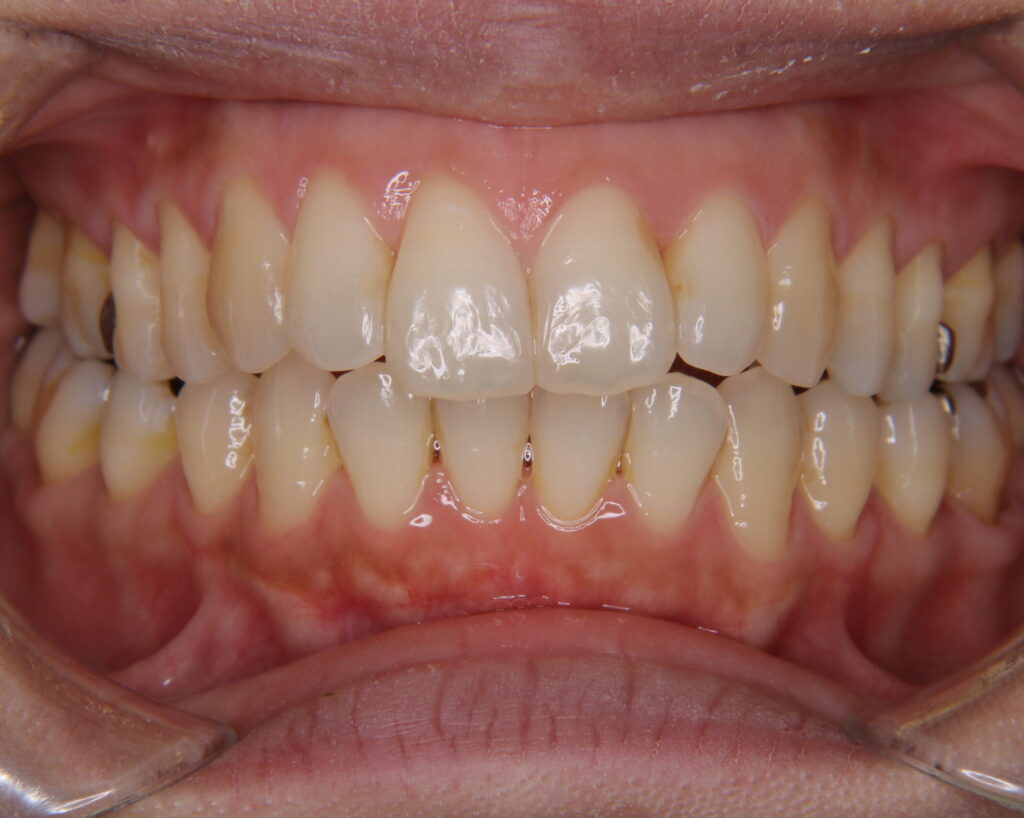 出っ歯・口ゴボ治療例３（治療後正面）