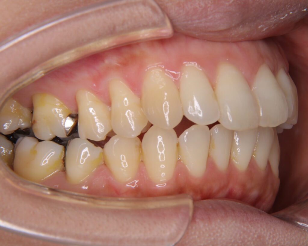 出っ歯・口ゴボ治療例３（治療後側方）